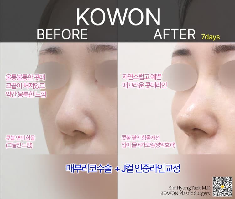 매부리코이면서 뭉툭한 복코, 전체적인 밸런스를 맞추는 포인트는? 수술 기록 사진