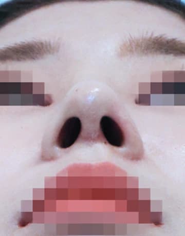 콧볼축소 코수술