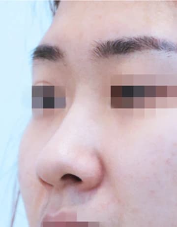 蒜头鼻手术