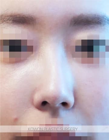 Deviated Nose Rhinoplasty