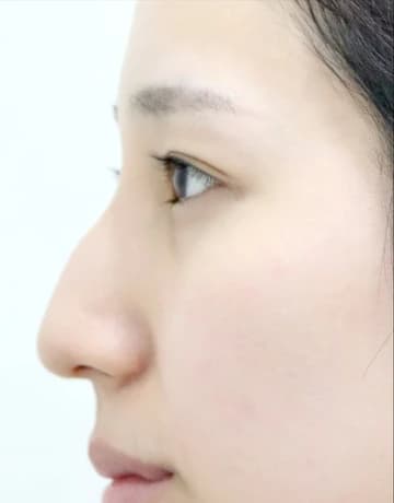 매부리코 코수술