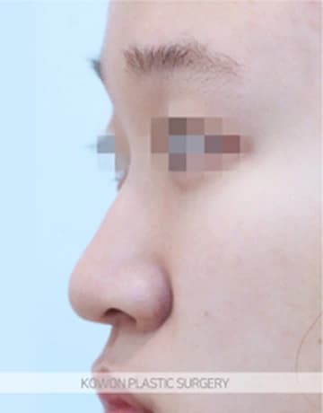 긴코·화살코 코수술