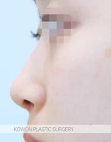 低い鼻の鼻手術