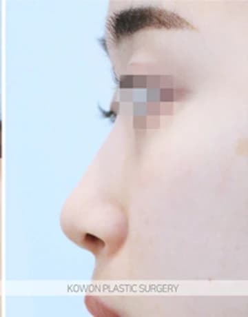 낮은코 코수술