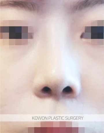 짧은코·들창코 코수술