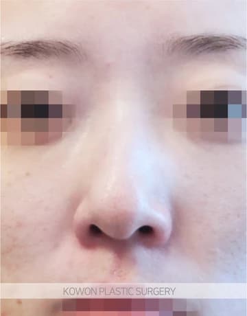 넓은콧대·코뼈축소 코수술