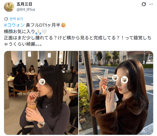 Patient review — 「横顔お気に入り」鼻整形1ヶ月