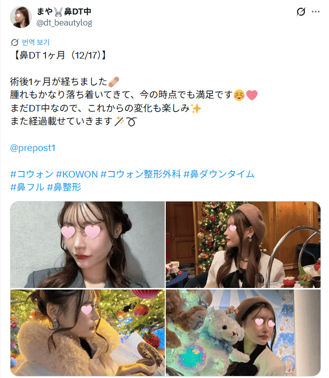 Patient review — 「腫れもかなり落ち着き大満足」鼻整形1ヶ月