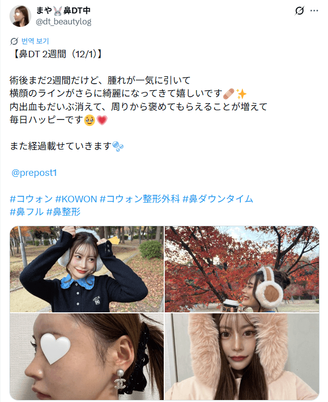 Patient review — 「横顔のラインがさらに綺麗になってきて嬉しい」鼻整形2週間