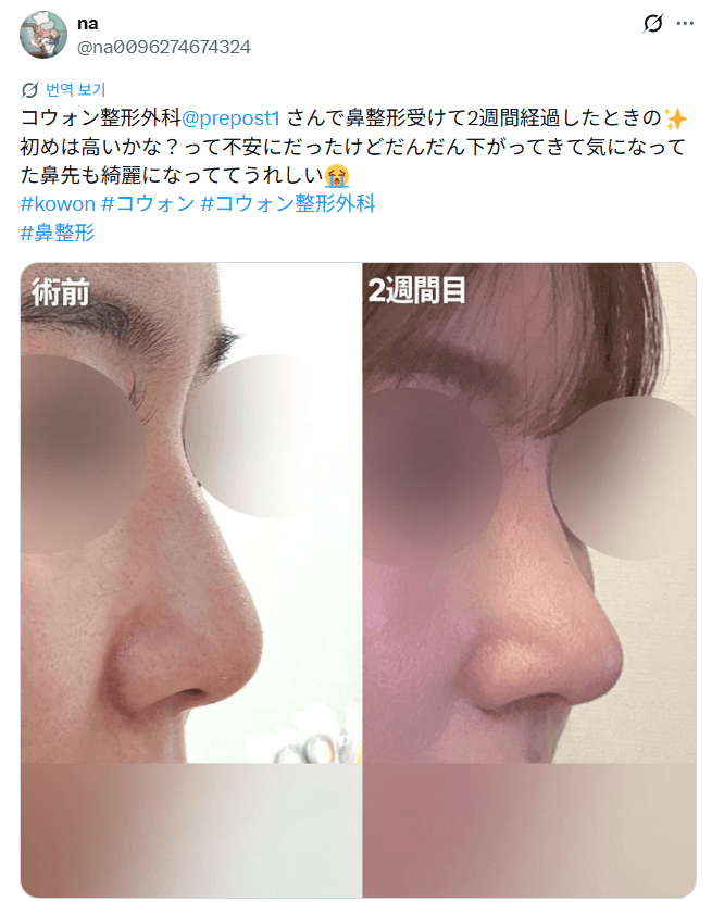 Patient review — 「気になっていた鼻先も綺麗になってきた」鼻整形2週間