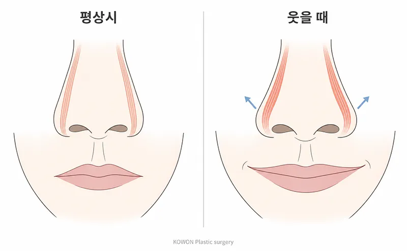웃을 때 콧볼 퍼짐 — 상순비익거근의 작용과 콧볼 확장 비교