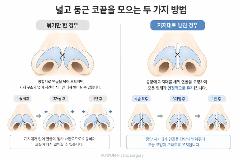 복코 코끝 교정 구조 — 연골을 모아 지지대로 받쳐 재퍼짐을 막는 방식