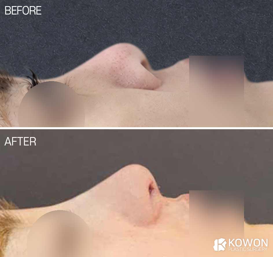 복코·낮은코·들린코·짧은코, 자가늑연골로 개선한 코수술 전후사진(수술 직후)