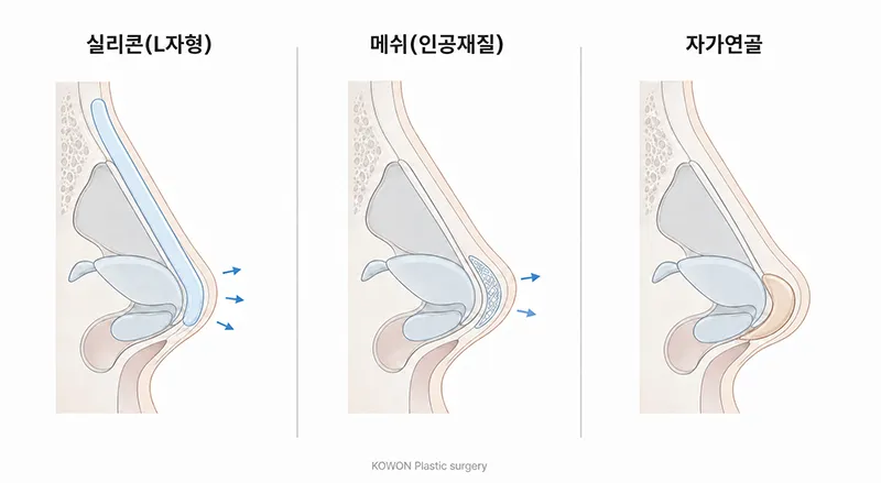 코끝 재료 비교 — 인공 보형물과 자가연골 지지대의 차이