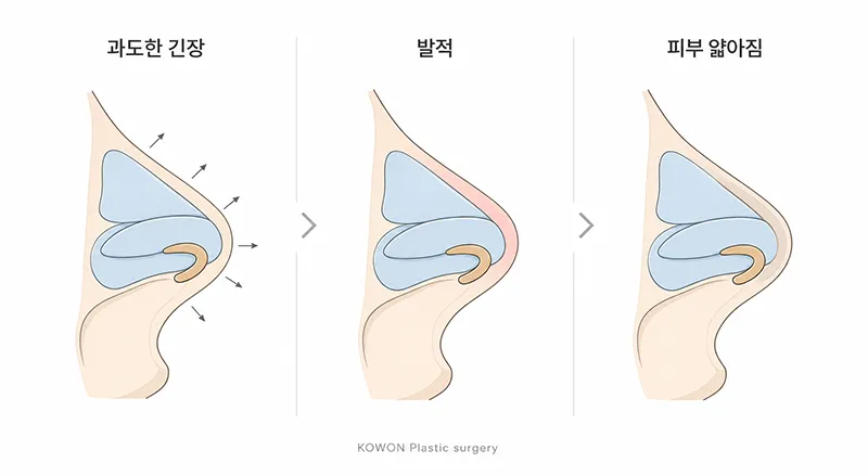 코끝 피부 얇아짐 진행 단계 — 발적에서 보형물 비침까지의 단면 구조