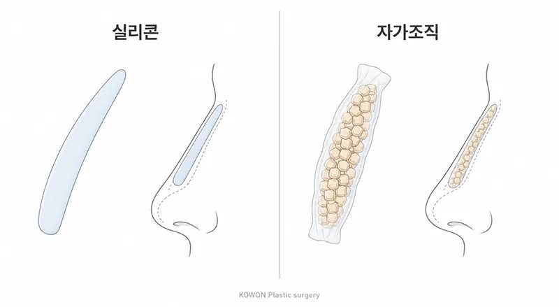 콧대 재료 비교 — 실리콘과 자가조직의 성질 차이