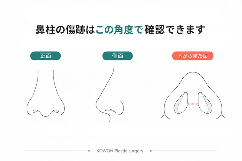 鼻柱の傷跡が見えやすい角度