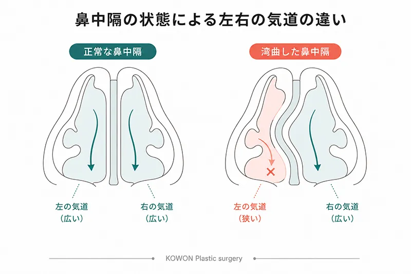 正常な鼻中隔と湾曲した鼻中隔の気道比較