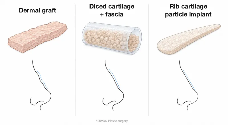 Comparison of a dermal graft, diced cartilage wrapped in fascia and a rib cartilage particle implant, with the bridge line each creates