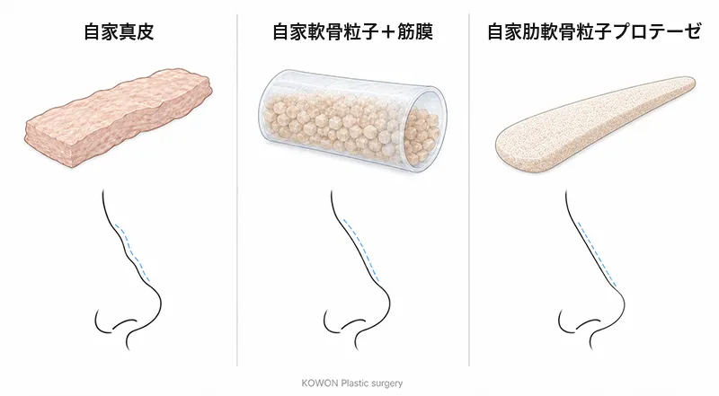 自家真皮・筋膜で包んだ自家軟骨粒子・自家肋軟骨粒子プロテーゼと、それぞれがつくる鼻筋のラインの比較