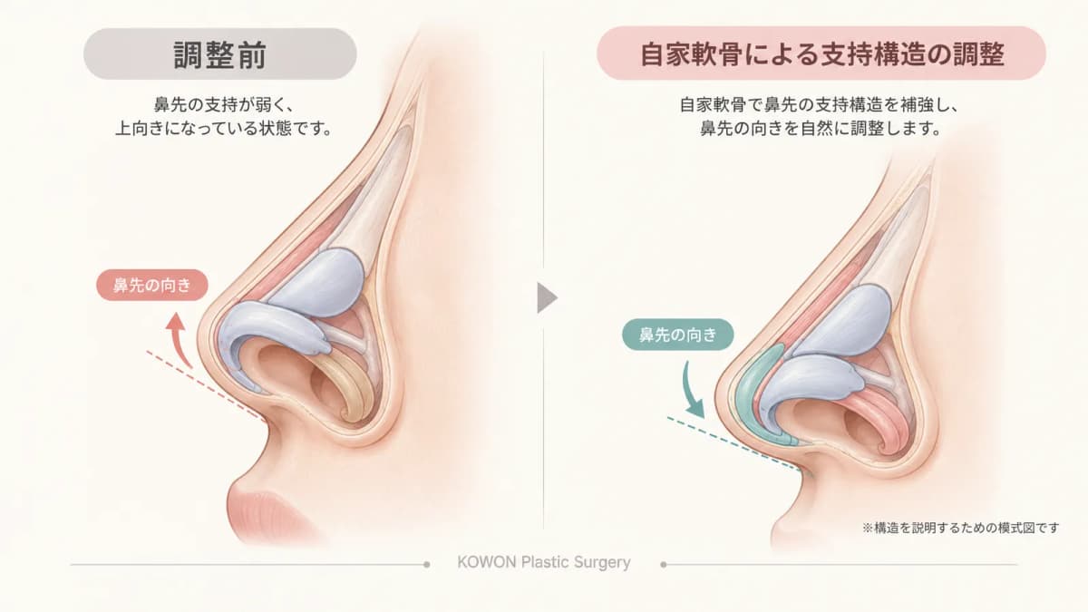 自家軟骨による鼻先の支持構造調整