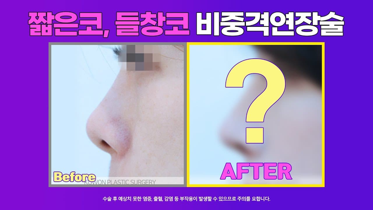 짧은코, 들창코 전후: 비중격연장술, 비대칭콧구멍 교정
