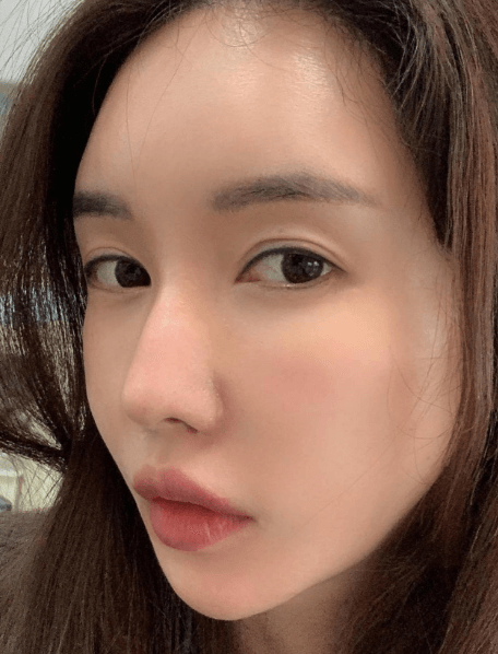 자가 늑연골 수술 수술후기 사진 1