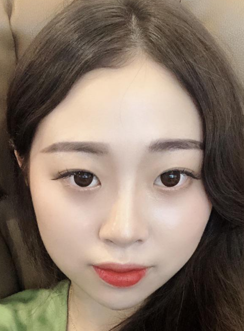 이제 딱 한달차네요!! 수술후기 사진 2