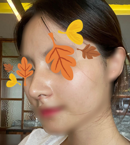 보면서 흐뭇해 합니다 ㅎㅎㅎ 수술후기 사진 2