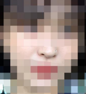 2주차 후기 올립니다! 수술후기 사진 4