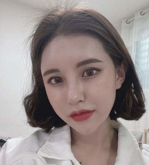코 재수술+지방이식 너무 만족 합니다 ㅠㅠ 수술후기 사진 2