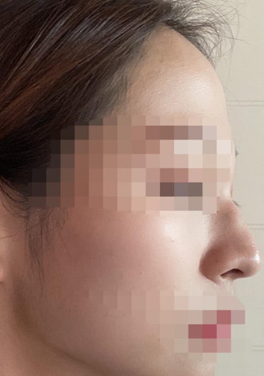 점점 자연스러워져서 좋아요 ㅎㅎㅎㅎ 수술후기 사진 2