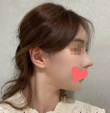 이쁘죠?? 수술후기 사진 2