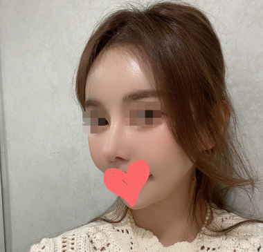이쁘죠?? 수술후기 사진 3