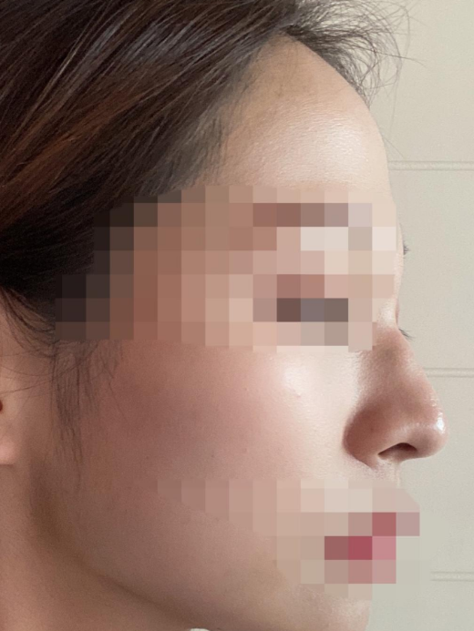 코수술 한지 한달차 입니당 ㅎㅎ 수술후기 사진 2