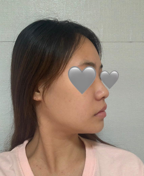 김형택 원장님 라인하나는 진짜 최고인것 같아요♥♥♥ 수술후기 사진 4