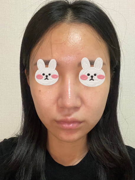 코원성형외과에서 코 재수술한지 2달차입니당 수술후기 사진 4