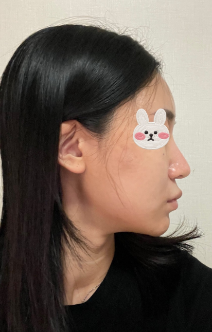 코원성형외과에서 코 재수술한지 2달차입니당 수술후기 사진 3
