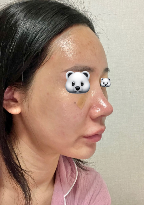 전후차이 보면 너무 신기해요 수술후기 사진 2