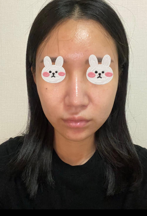 전후차이 보면 너무 신기해요 수술후기 사진 3