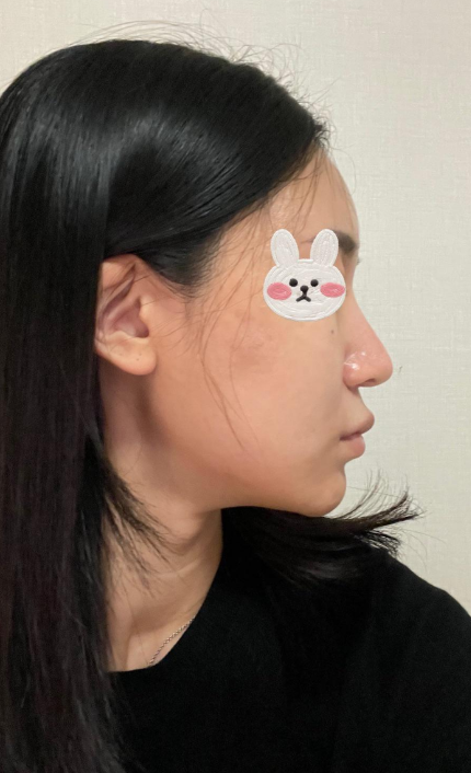 전후차이 보면 너무 신기해요 수술후기 사진 4