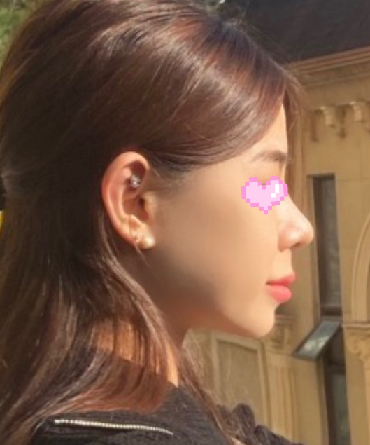 얼굴이 더 작아보인대요 수술후기 사진 2