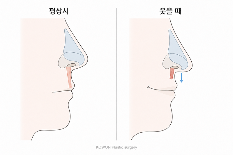 웃을 때 코끝 내려오는 건 근육 때문이라던데 근육교정은 어떤 수술인가요?