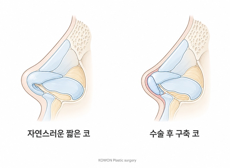 코수술부작용으로 들창코가 됐어요, 일반 들창코랑 수술방법이 다른가요?
